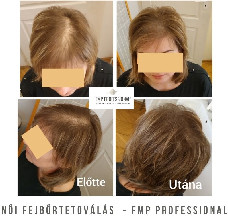 Női fejbőrtetoválás kopaszság